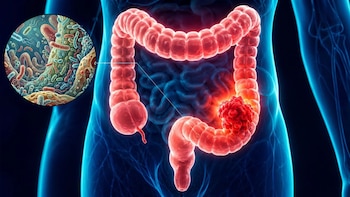 Científicos identifican probiótico que ayuda a eliminar tumores causantes de cáncer de colon