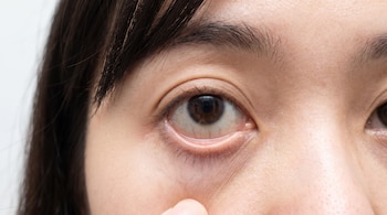 Primer plano de un ojo humano con el párpado inferior descendido por un dedo. Se observa la conjuntiva del ojo.