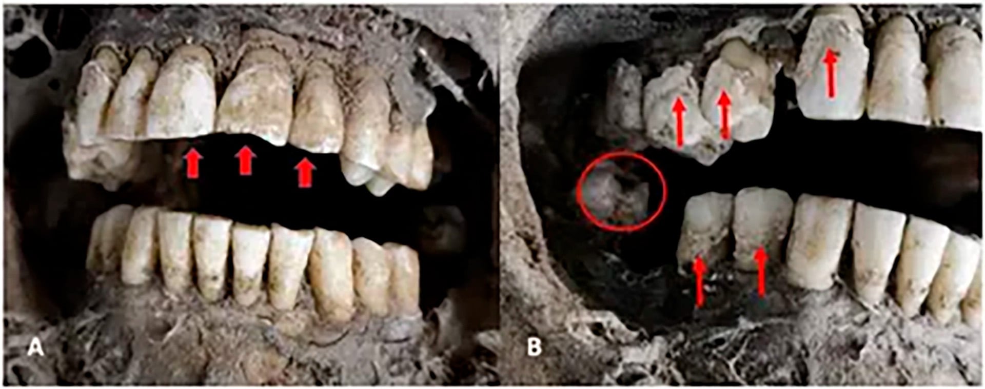 La dentadura de la momia está bien conservada, con desgaste leve, signos de periodontitis, sarro y una caries en un molar inferior derecho (Frontiers)