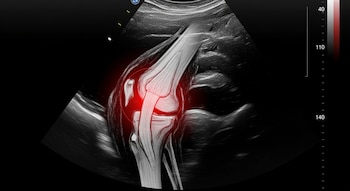 Imagen de ultrasonido de una rodilla con una ilustración superpuesta de la articulación y un área roja resaltada. Una escala numérica vertical aparece a la derecha.