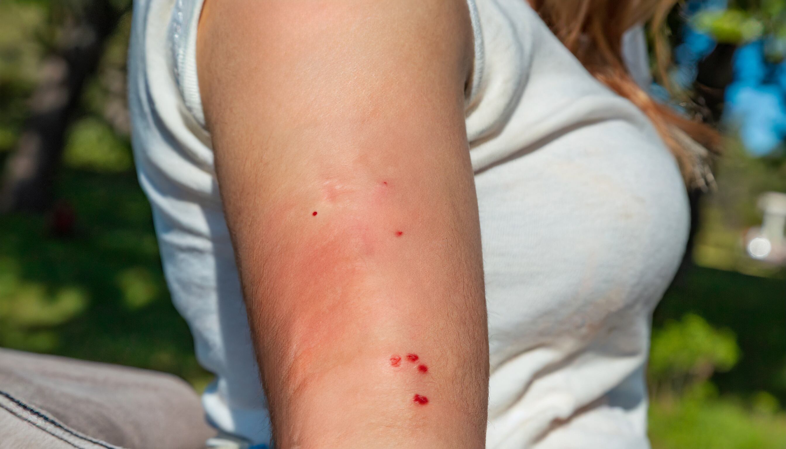 Persona con picaduras de mosquito en el brazo (Imagen Ilustrativa Infobae)