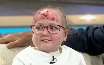 Una niña con anteojos y marcas en la frente permanece sentada en un sofá claro dentro de un estudio de televisión
