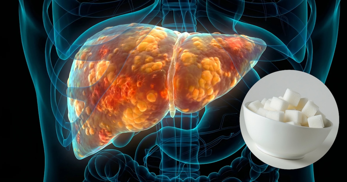Fat liver: the sweetener that accelerates the deterioration of this organ in those suffering from this condition