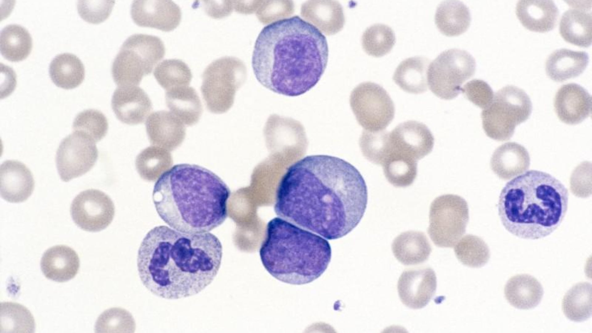La leucemia se origina en la médula ósea, donde se produce un aumento descontrolado de células sanguíneas anormales. (NIH)
