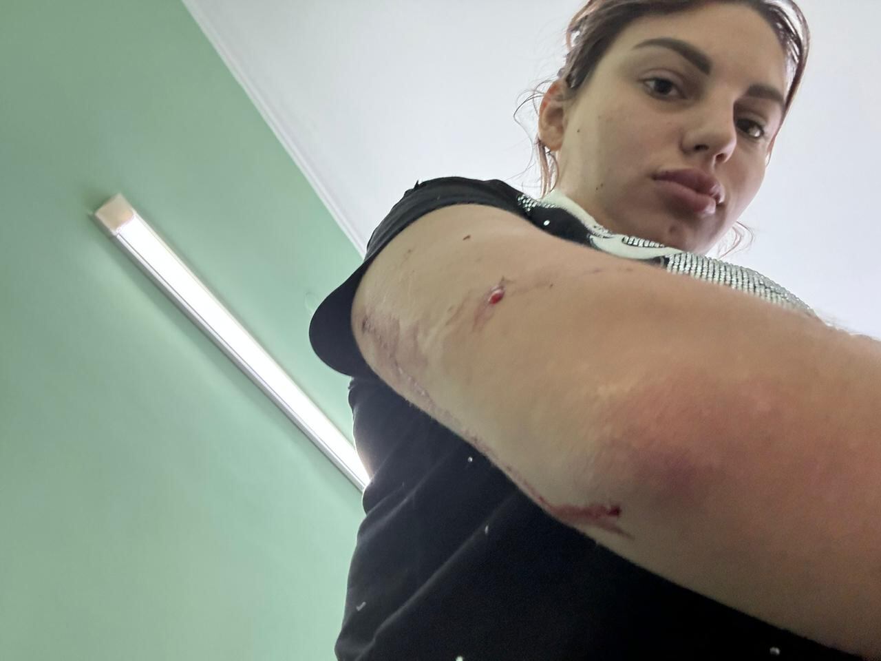 Anastasia Pavlenko muestra su brazo herido (Archivo personal de Anastasia Pavlenko)