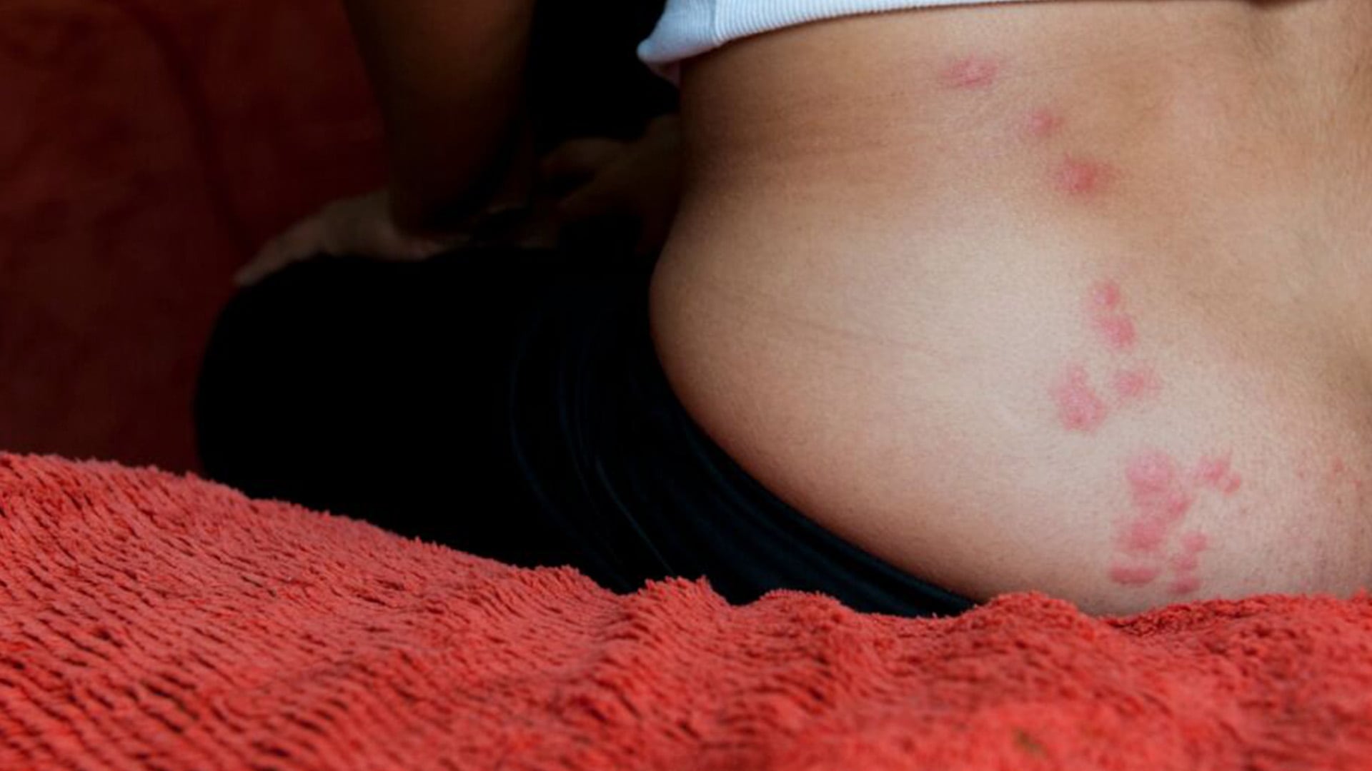 La picadura de chinche puede transmitir la llamada Enfermedad de ChagasFoto:TV Azteca