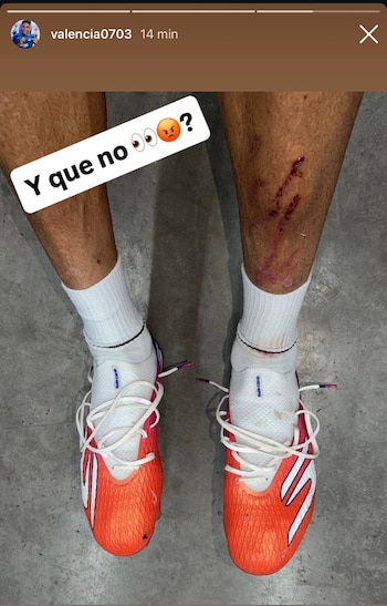 El volante luego borró la historia del cómo quedó su pierna en las redes sociales-crédito @valencia0703-X-Instagram