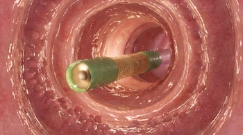 Dispositivo tubular con punta circular y cubierta de malla dorada en el interior de una cavidad orgánica rosada con pliegues.