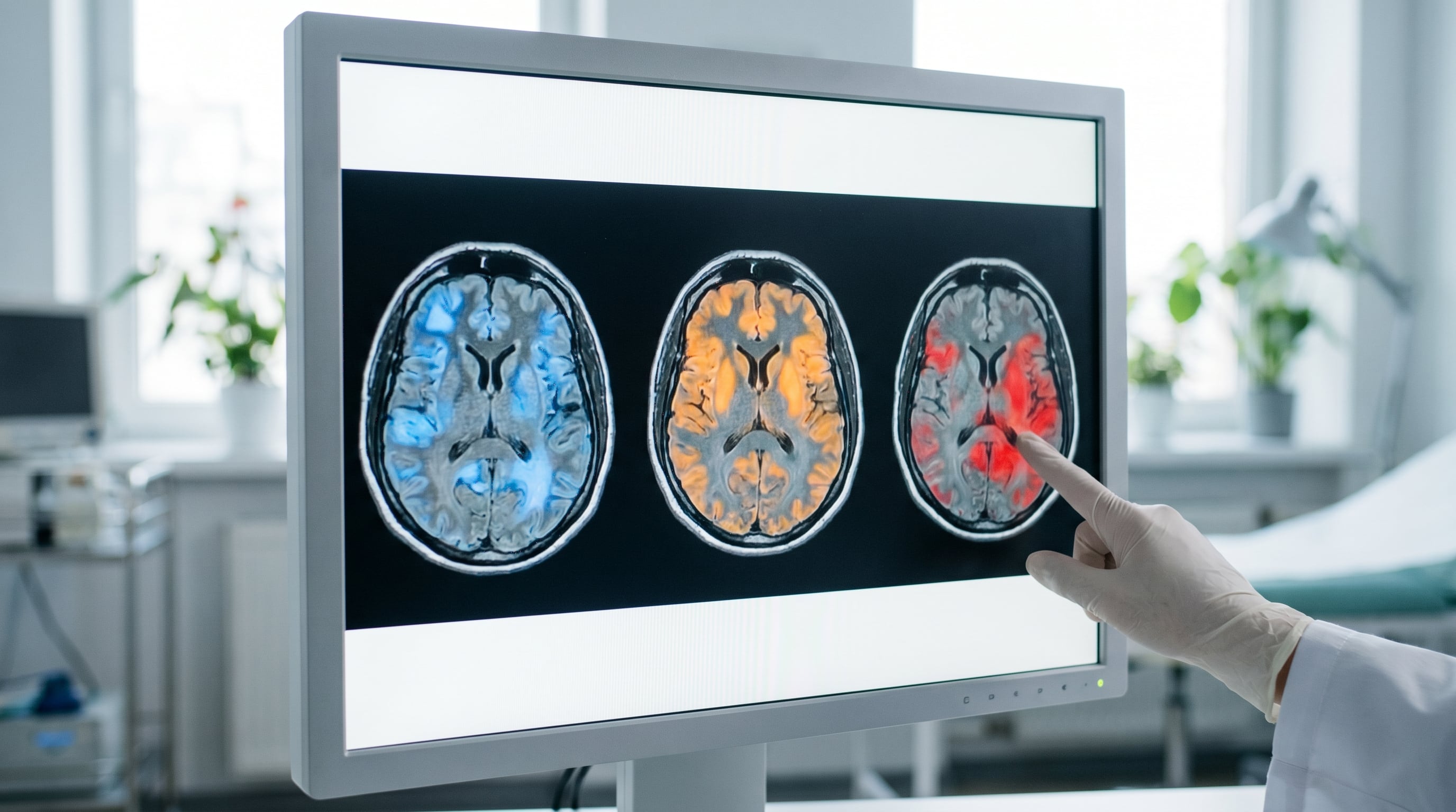 Solo entre un 10% y un 15% de los casos de deterioro cognitivo leve avanzan a demencia cada año, según estudios citados por la Cleveland Clinic (Imagen Ilustrativa Infobae)