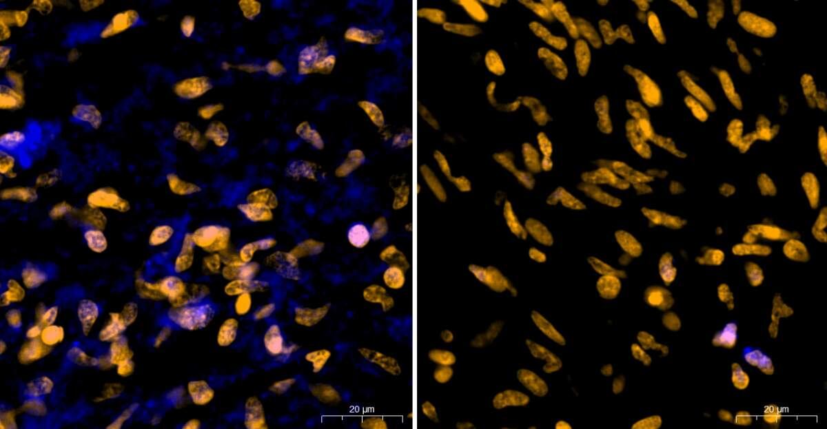 Tejido tumoral de glioblastoma. A la izquierda, las células cancerosas cuyos núcleos están marcados en naranja han absorbido el aminoácido marcado en azul, lo que evidencia la presencia de bacterias vivas y activas dentro del tumor. A la derecha, tras el tratamiento con antibióticos, la absorción del aminoácido cesó.
Foto: Instituto Weizmann de Ciencias