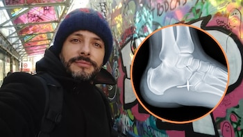 Actor de ‘Sin senos no hay paraíso’ reveló que casi pierde un pie por una pequeña fractura: “Hay riesgo de necrosis”