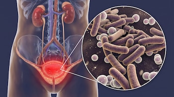 Torso humano semi-transparente mostrando riñones, ureteres y vejiga con zona roja, junto a círculo ampliado con bacterias cilíndricas y esféricas