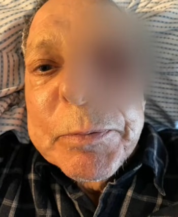 El actor César Bono permanece en observación tras la cirugía en la que le extirparon el ojo izquierdo por un tumor.