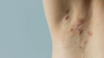 Los síntomas incluyen espinillas negras,