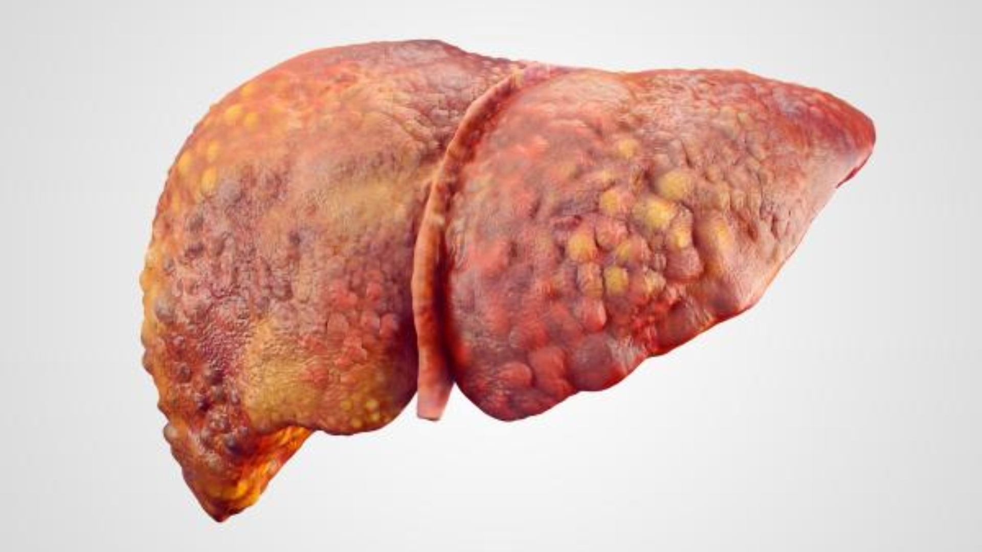 Importancia del seguimiento médico si tienes hígado graso diagnosticado
(RS)