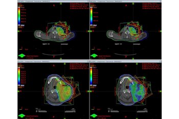 Acelerador lineal enviando radiación a