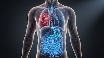 Una revisión científica identificó al microbioma intestinal como un posible factor clave en la eficacia de los tratamientos contra el cáncer