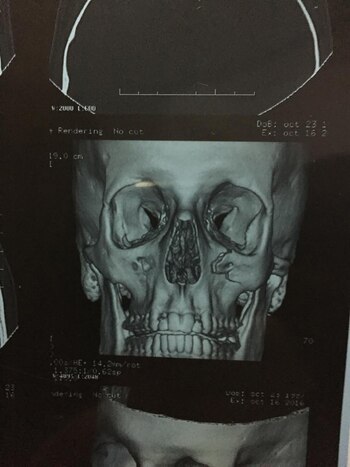 “Vivo con 4 tornillos y