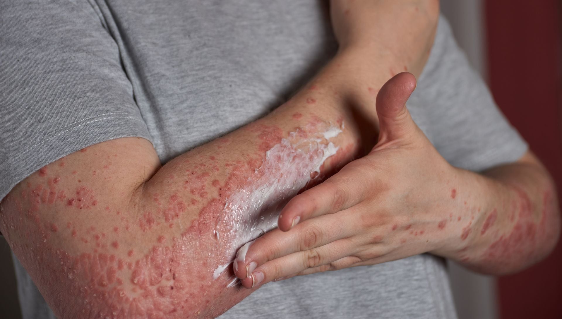 Existen distintos tipos de psoriasis, como en placas, en gotas, inversa, pustulosa y eritrodérmica, cada una con síntomas y zonas de aparición diferentes (Freepik)
