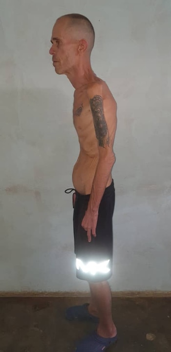 Vista lateral de Alexander Díaz Rodríguez, un hombre muy delgado con el cráneo rapado, mostrando costillas prominentes y abdomen hinchado, vistiendo shorts oscuros y sandalias