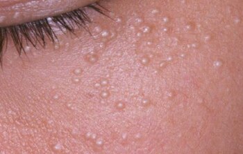 El efecto comedogénico del aceite