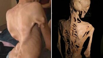 Cuerpos afectados por la enfermedad