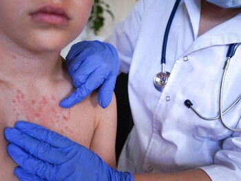 El sarampión es una enfermedad altamente contagiosa que afecta principalmente a niños y personas no vacunadas. (FOTO: La Prensa)