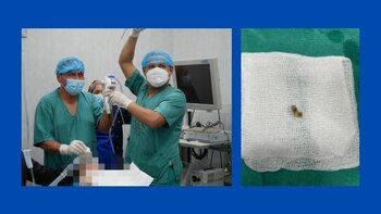 Médicos del Minsa lograron extraer