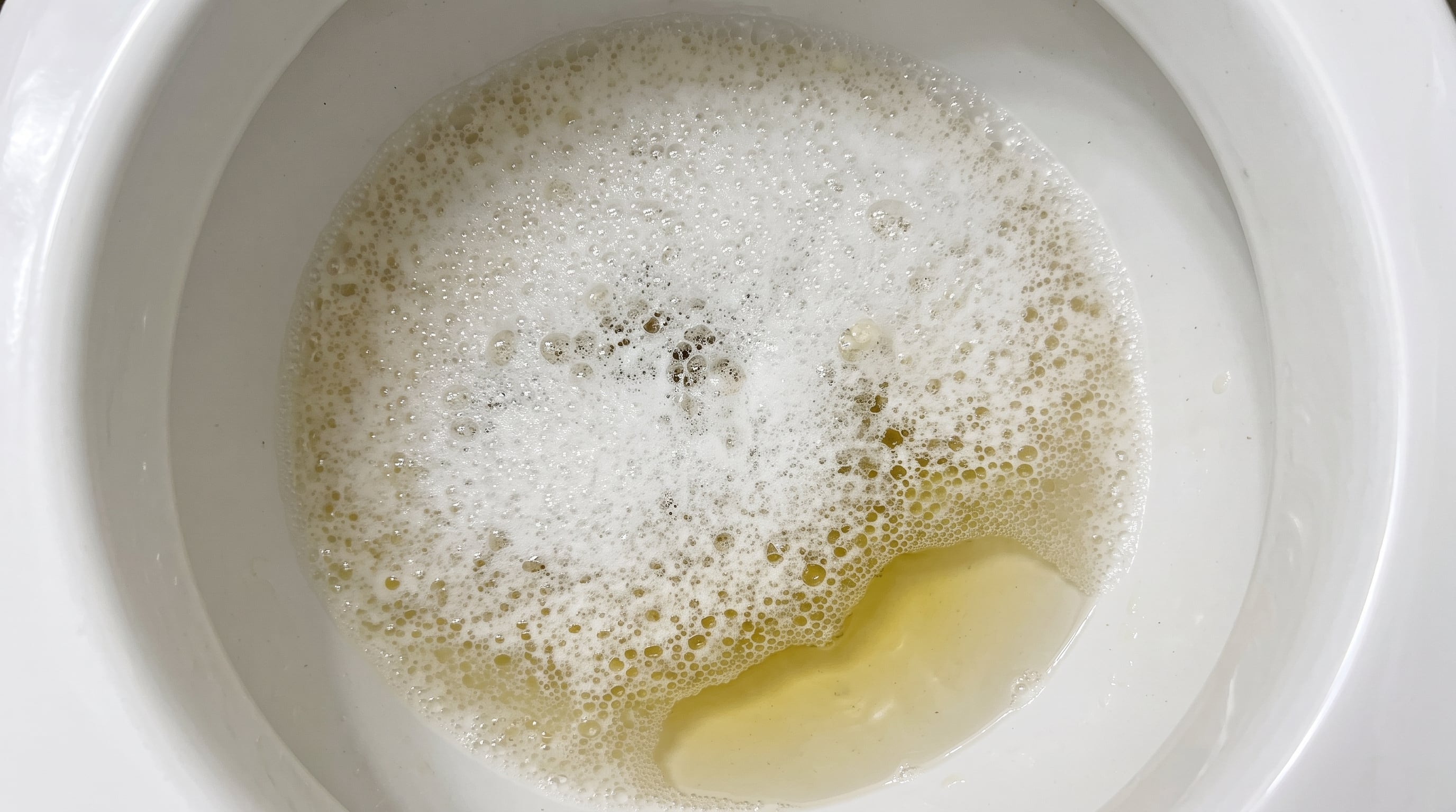 La presencia de espuma persistente en la orina es la principal característica que requiere consulta médica (Imagen Ilustrativa Infobae)