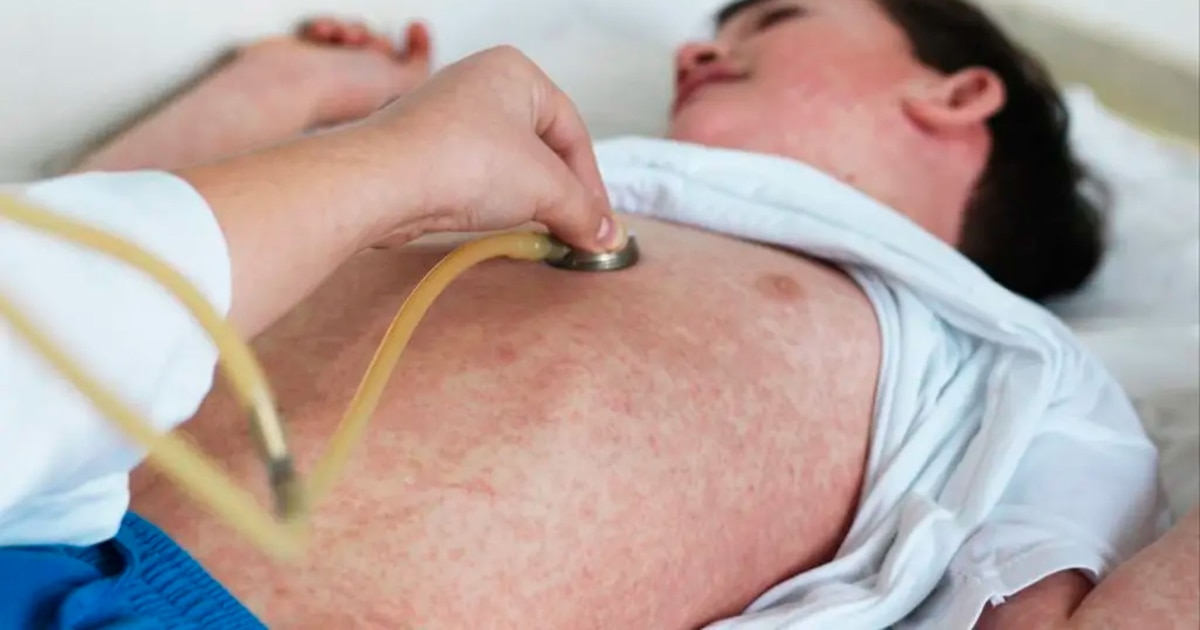 Alerta Roja por Sarampión en Argentina: Autoridades Investigan Centenares de Sospechosos Casos