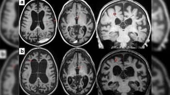 Seis imagens de tomografia computadorizada do cérebro humano em vistas axial e coronal, mostrando os ventrículos e o tecido cortical em tons de cinza