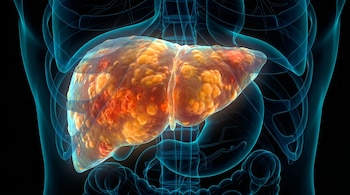 Ilustración 3D de un hígado graso dañado con depósitos amarillos y naranjas e inflamación. Líneas azules transparentes lo rodean sobre fondo negro.
