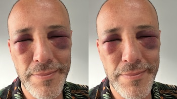 Actor de ‘Padres e hijos’ se realizó un implante de cabello que le dejó el rostro irreconocible por la inflamación
