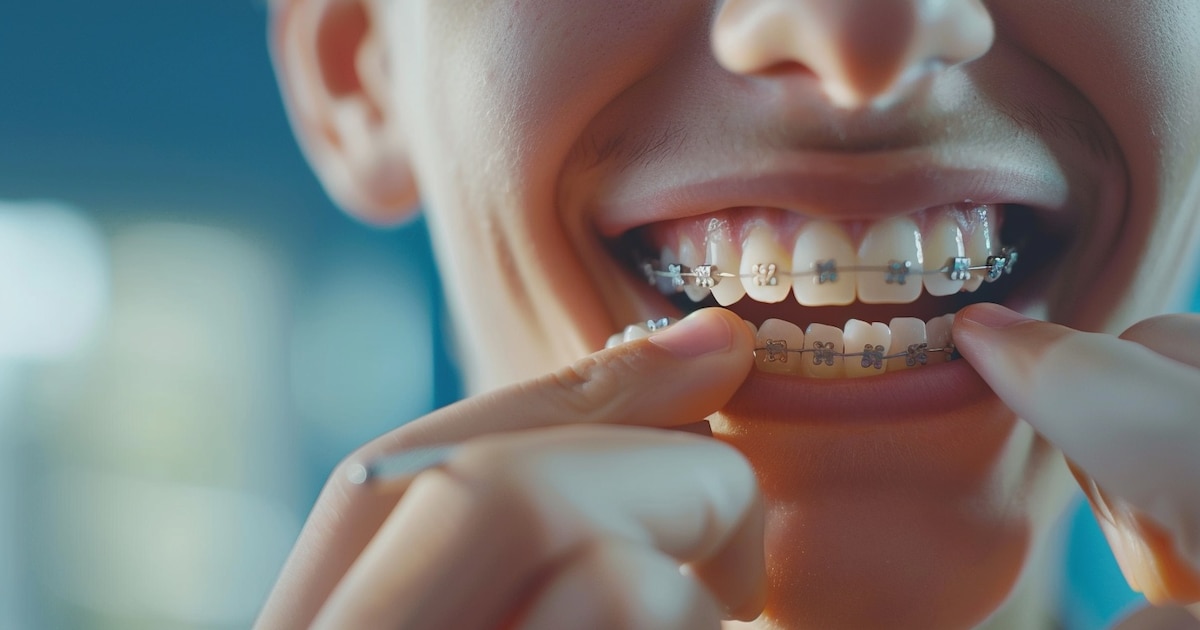 ¡El Regreso Triunfal de los Brackets Metálicos: La Ortodoncia Clásica Vuelve con Fuerte Presencia!