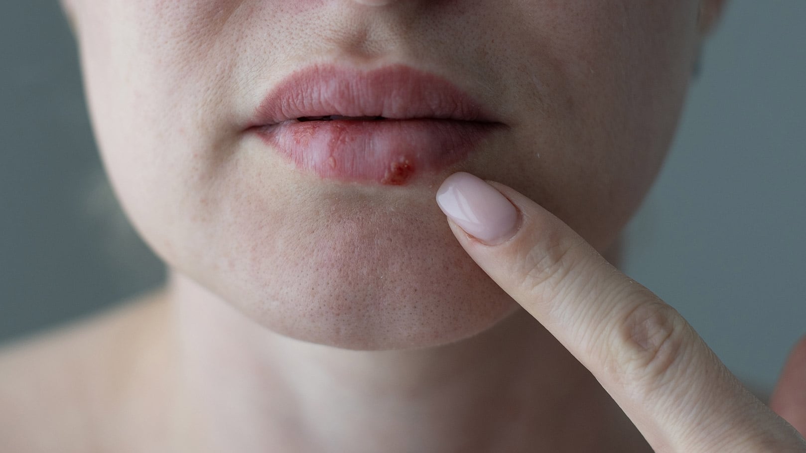 FDA aprueba pritelivir, primer antiviral oral contra herpes resistente en casi 30 años