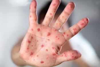 INS advierte sobre aumento de