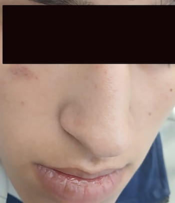Primer plano del rostro de una persona. La parte superior de la frente está cubierta por un rectángulo negro. Se observan nariz, boca, marcas rojizas en la piel y labios resecos