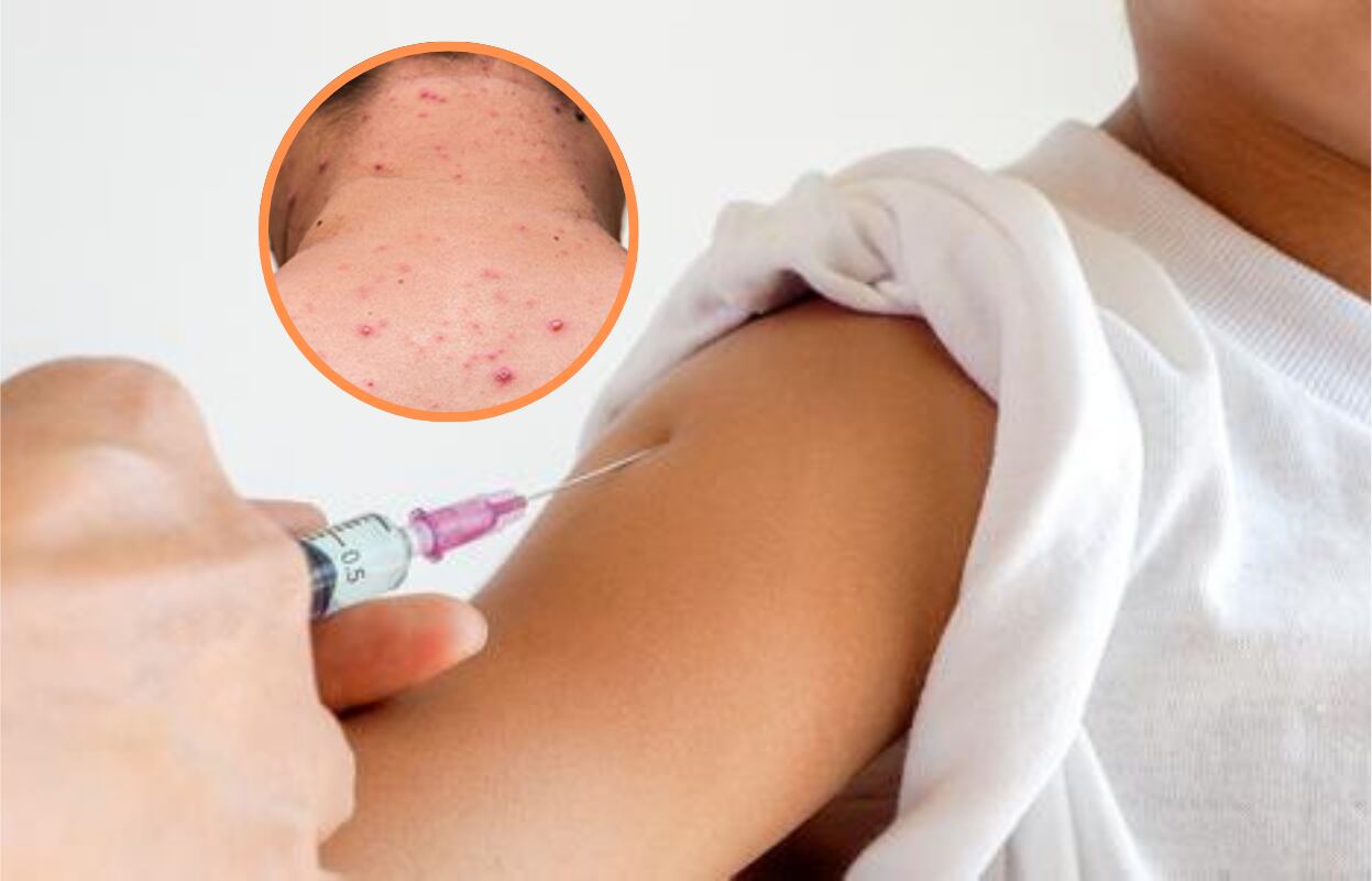 Detectan caso de sarampión en Surco. (Foto: Composición)