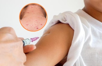 Detectan caso de sarampión en