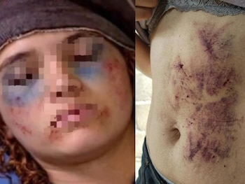 La mujer habría utilizado herramientas de inteligencia artificial para crear imágenes falsas de golpes y hematomas con las que buscaba respaldar su historia. (Foto: Policía Nacional)