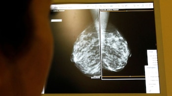 La IA podría detectar enfermedades cardiacas en mujeres mediante mamografías