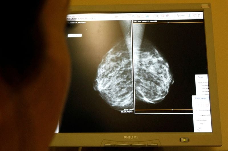 Un equipo de investigadores israelíes entrenó un modelo de inteligencia artificial con casi 100.000 mamografías para detectar enfermedades del corazón en mujeres. (Reuters)