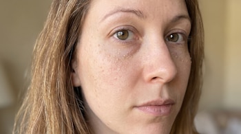 Primer plano del rostro de una mujer con pequeñas protuberancias claras bajo el ojo y sobre la mejilla.