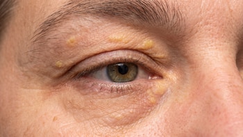 Si ves esta marca en el rostro, cuidado: un estudio relaciona esta señal con peligro de ataque cardíaco y derrame cerebral