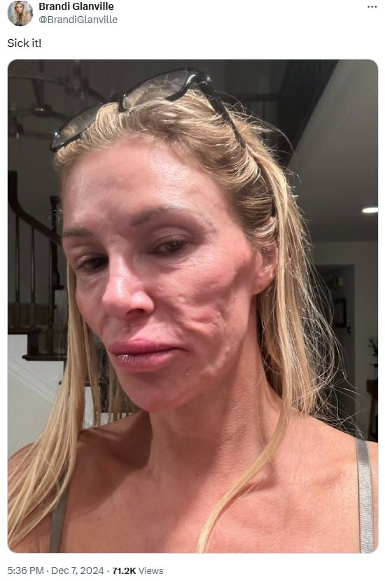 La conductora dijo que la exposición al sol, un medicamento antiparasitario y una dieta antiparasitaria fueron lo único que le había ayudado - (Brandi Glanville/X)