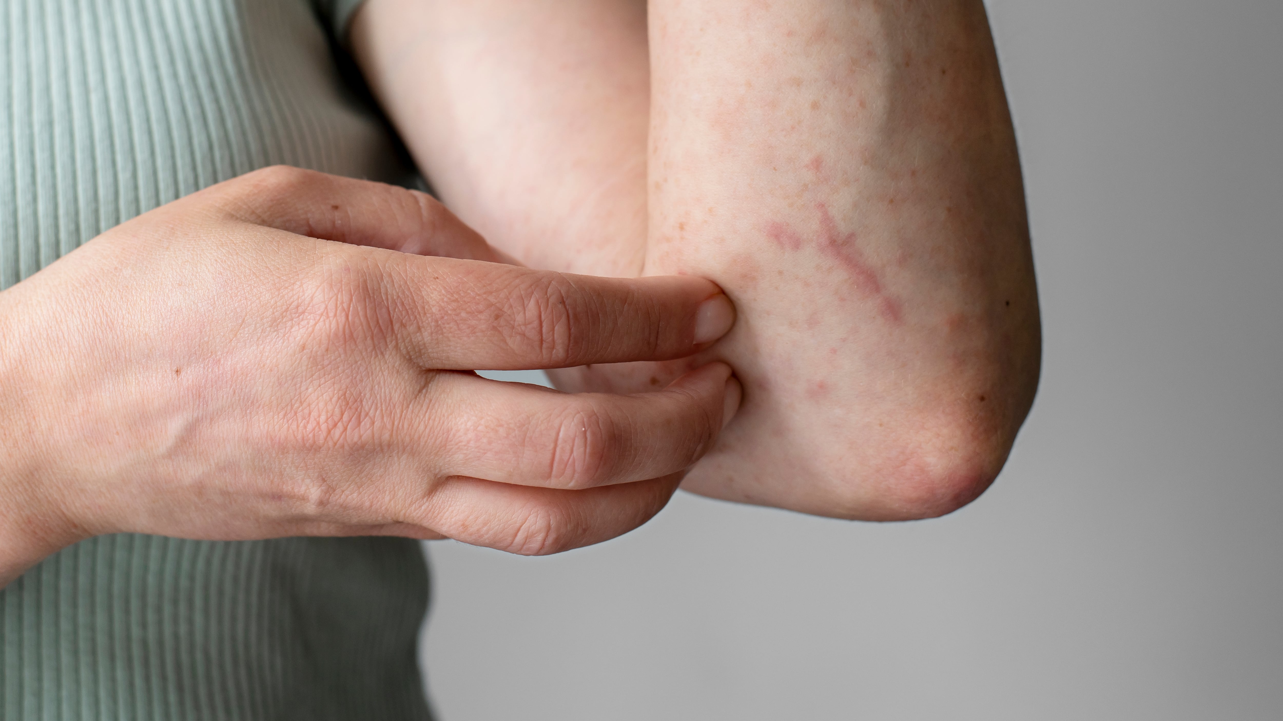La dermatitis atópica provoca brotes recurrentes de eczema que afectan la piel, la calidad de vida y el descanso diario (Crédito: Freepik)