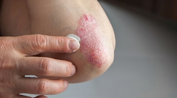 Primer plano de una mano aplicando una crema blanca sobre la piel irritada y escamosa de un codo, que muestra signos de psoriasis.