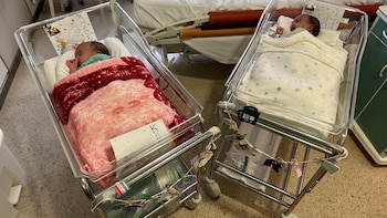 Separan con éxito a dos