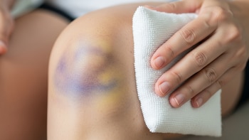 Golpes y moretones: cuál es