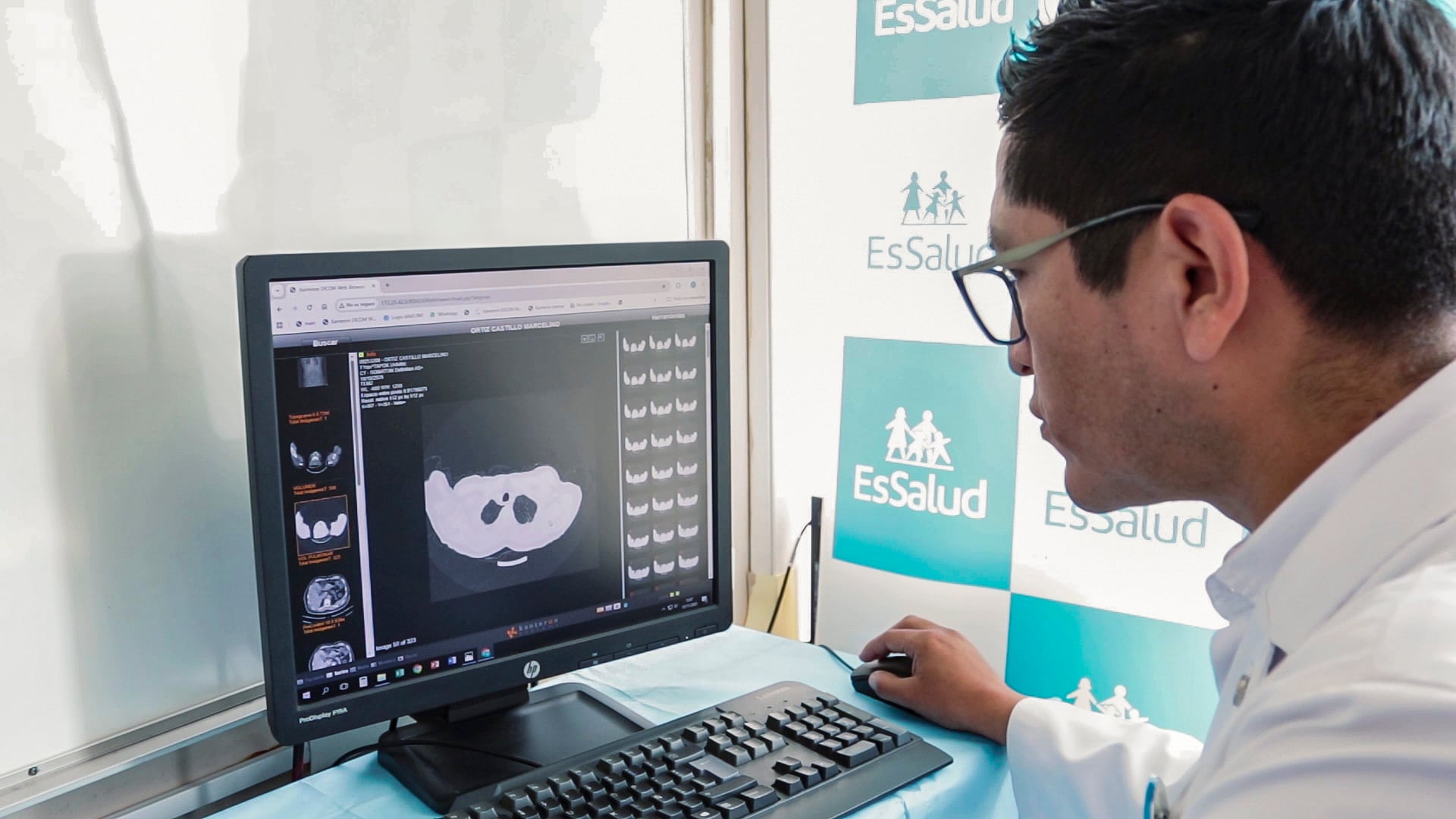 Un ensayo clínico con 210 pacientes mostró que la inmunoquimioterapia administrada antes de las 15 horas ralentiza el avance del cáncer de pulmón (EsSalud)